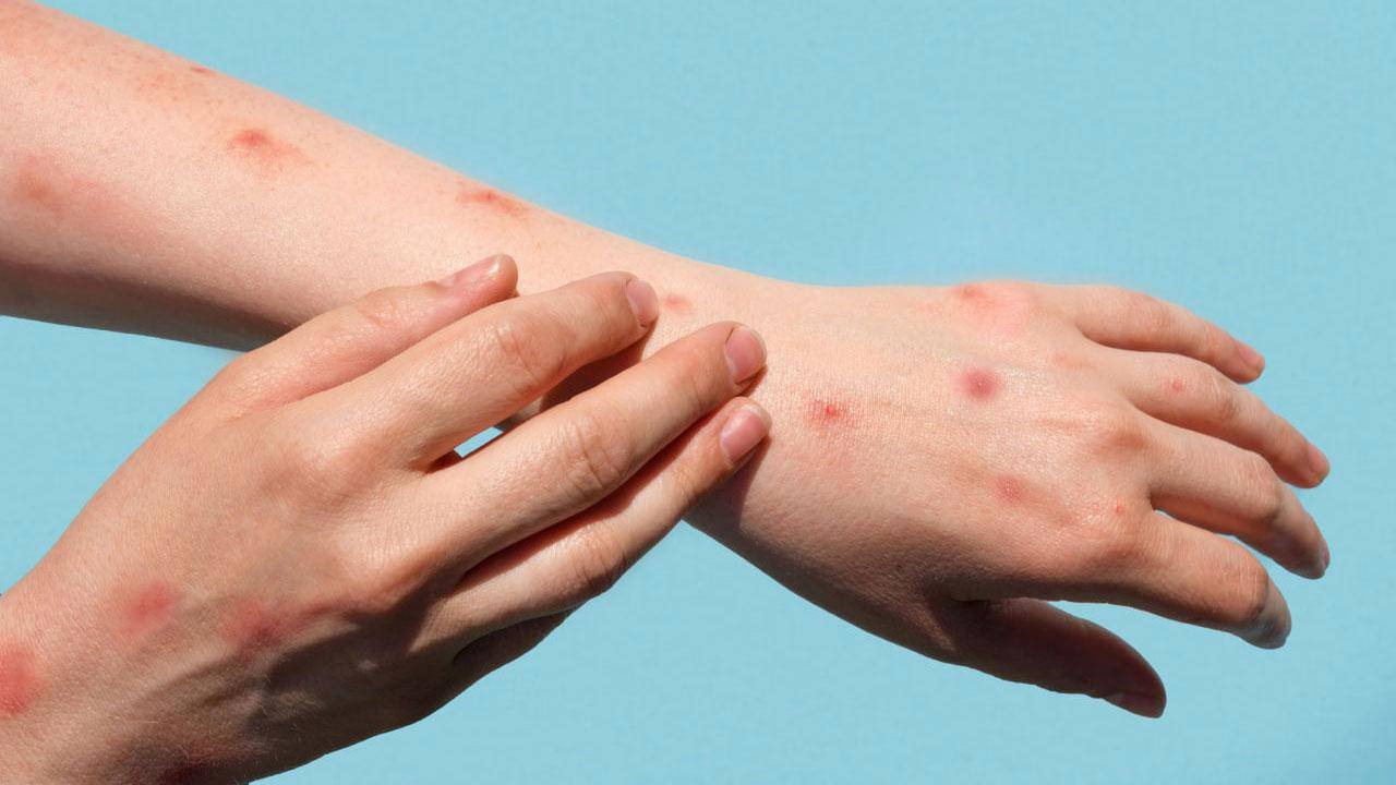Maymun Çiçeği Virüsü ve Olası Psikolojik Etkiler: Yeni Pandemi Kapıda mı?